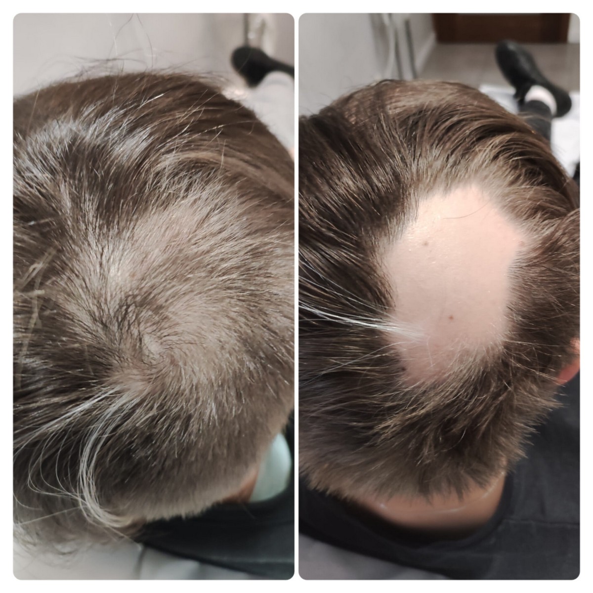 BLACK FRIDAY 3+1 GRATIS!!! ResurHair - Laserowa Stymulacja Wzrostu Włosów - obrazek 9