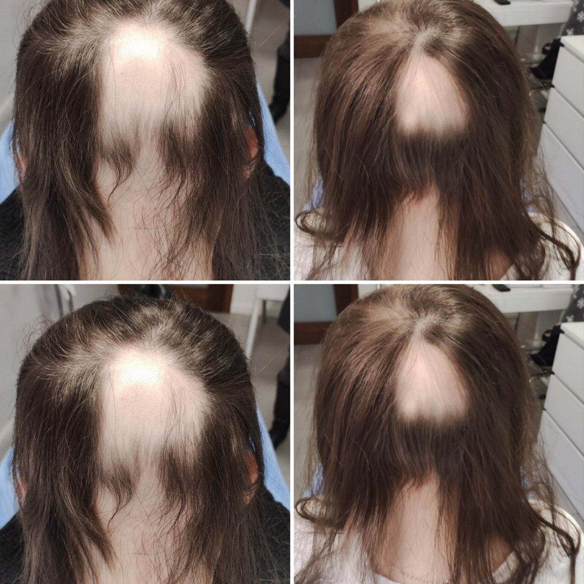 BLACK FRIDAY 3+1 GRATIS!!! ResurHair - Laserowa Stymulacja Wzrostu Włosów - obrazek 8