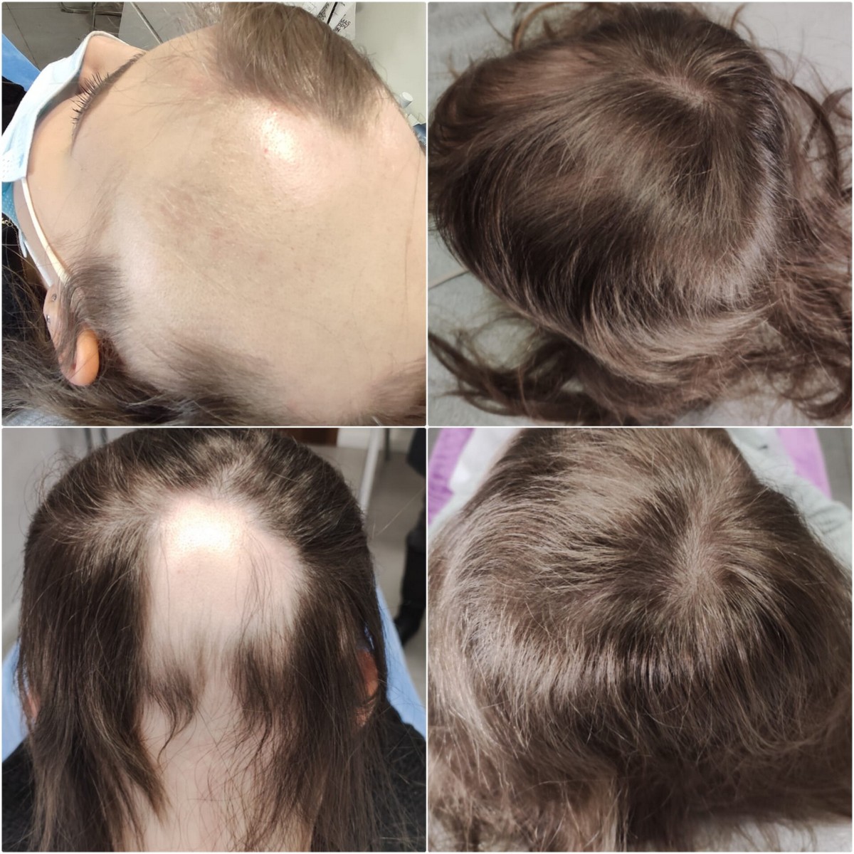 BLACK FRIDAY 3+1 GRATIS!!! ResurHair - Laserowa Stymulacja Wzrostu Włosów - obrazek 7