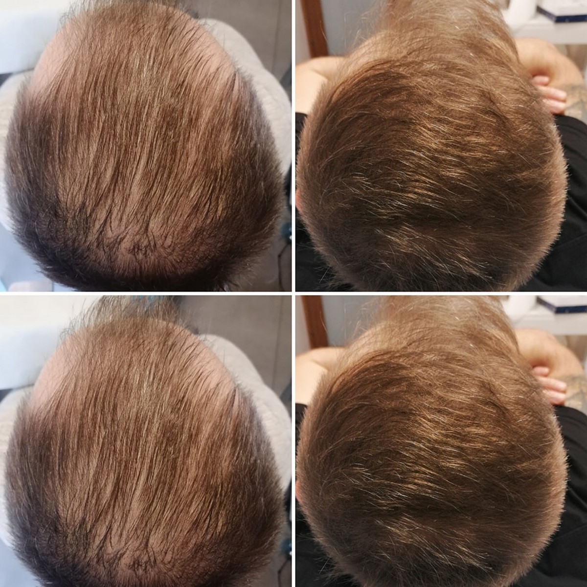 BLACK FRIDAY 3+1 GRATIS!!! ResurHair - Laserowa Stymulacja Wzrostu Włosów - obrazek 4