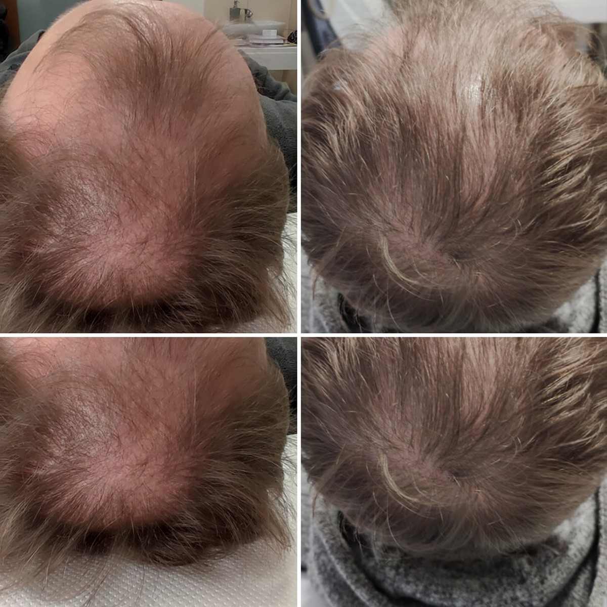 BLACK FRIDAY 3+1 GRATIS!!! ResurHair - Laserowa Stymulacja Wzrostu Włosów - obrazek 5