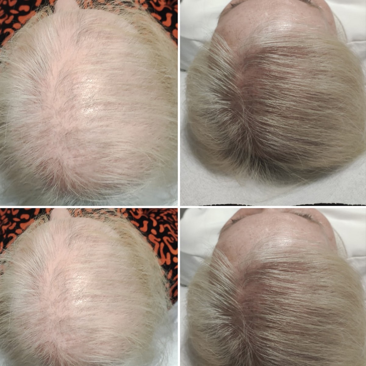 BLACK FRIDAY 3+1 GRATIS!!! ResurHair - Laserowa Stymulacja Wzrostu Włosów - obrazek 6