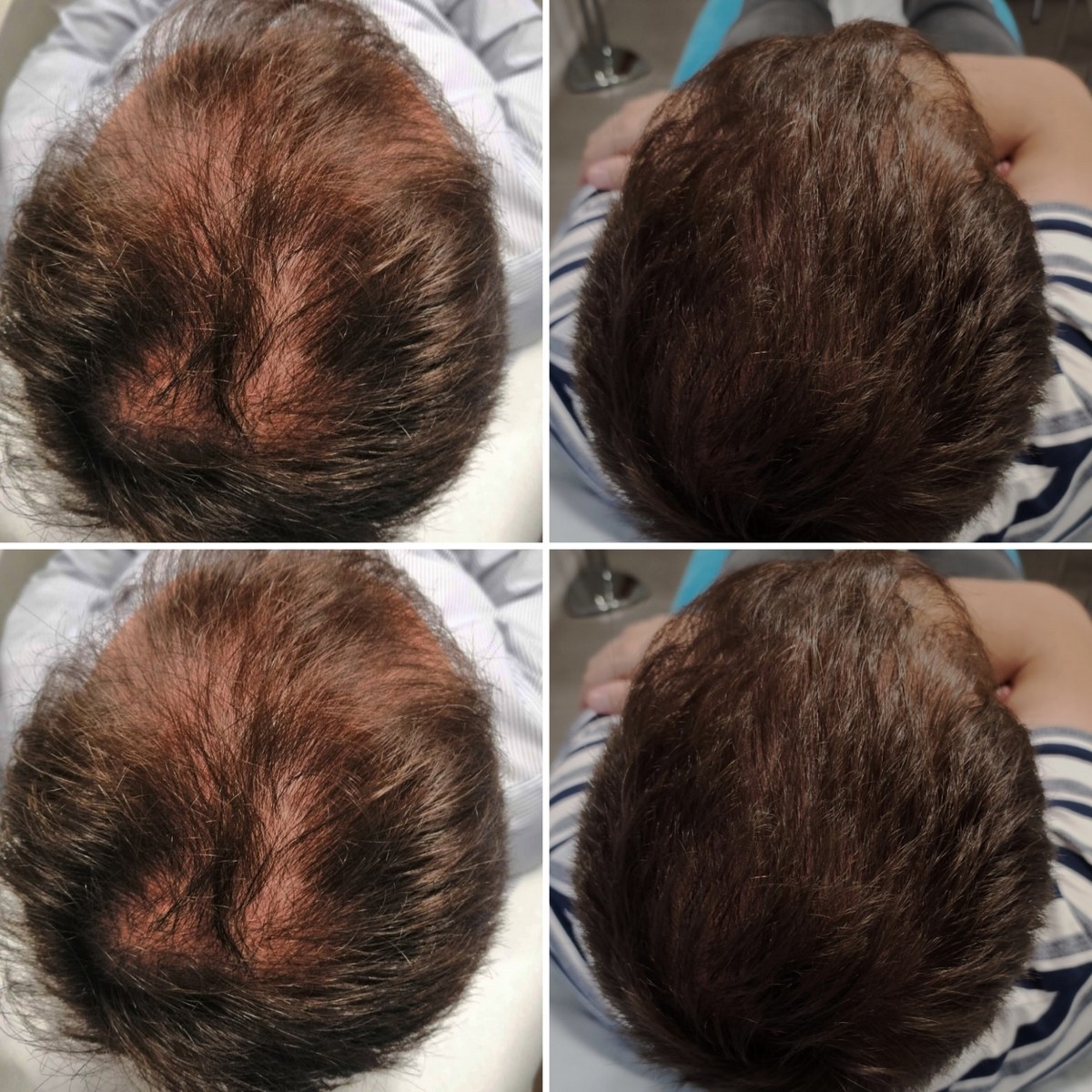 BLACK FRIDAY 3+1 GRATIS!!! ResurHair - Laserowa Stymulacja Wzrostu Włosów - obrazek 2